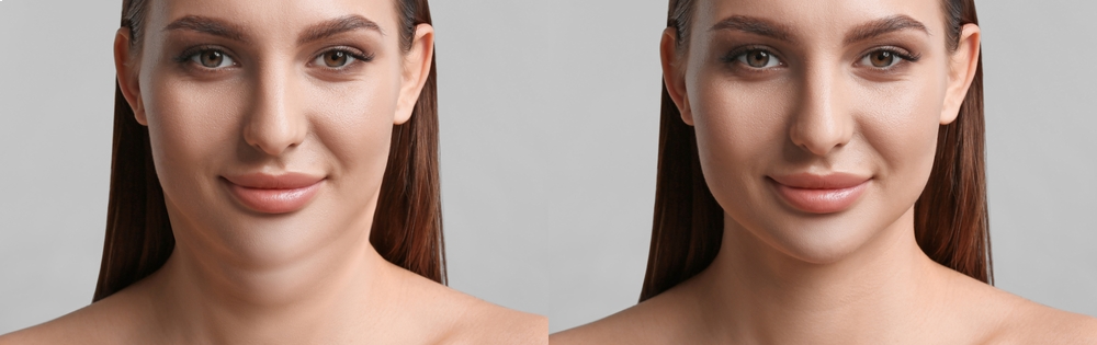 Before and after comparison showing dramatic results of a Kybella treatment for chin fat reduction.