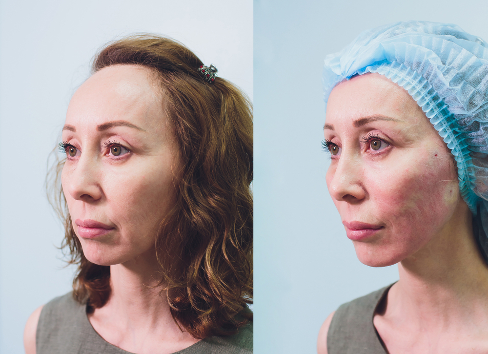 Before and after results showcasing the transformative effect of a PDO thread lift.