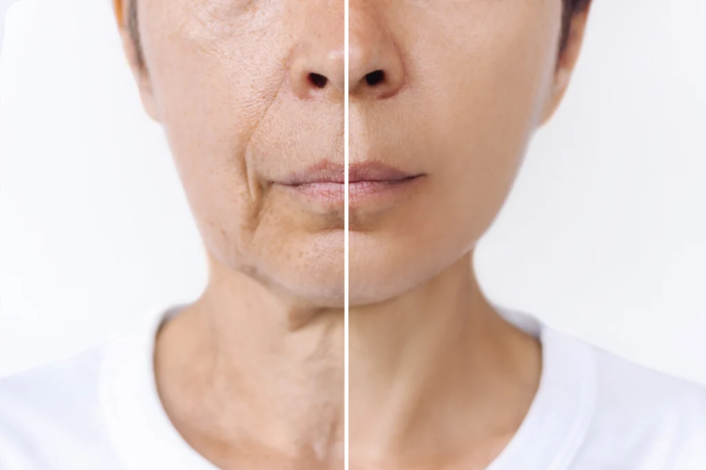 A before-and-after comparison showcasing the results of PRF injections.