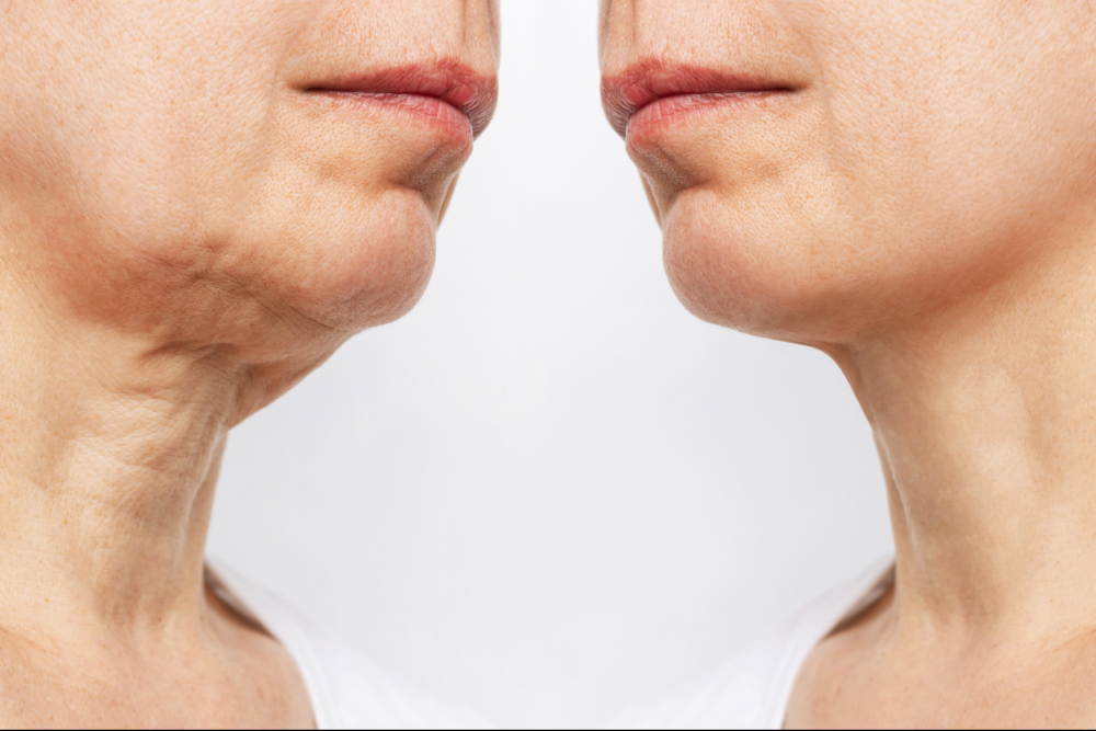 Before and after results of chin fillers for tightening and contour