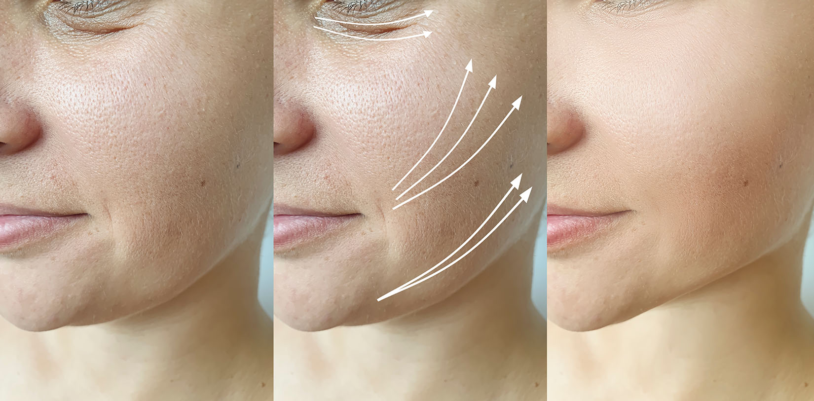 Three side-by-side facial images showing cheek area with and without visible guide lines